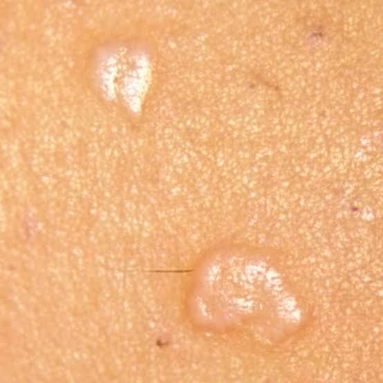 편평사마귀 사진 치료 참고 사진