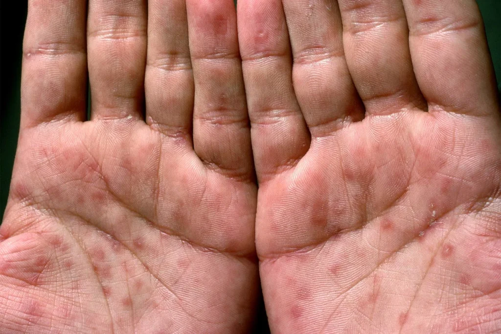 HIV와 감별이 필요한 손바닥 피부 발진 참고 사진