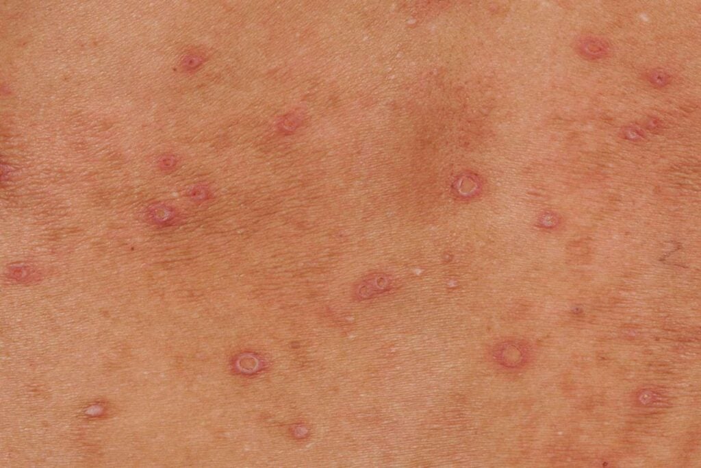 HIV 초기증상과 감별이 필요한 몸통 피부 발진 참고 사진