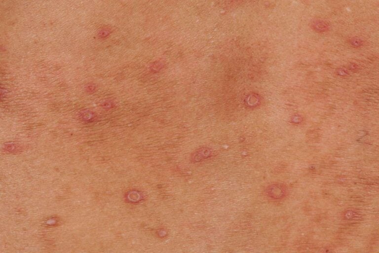 HIV 초기증상과 감별이 필요한 몸통 피부 발진 참고 사진