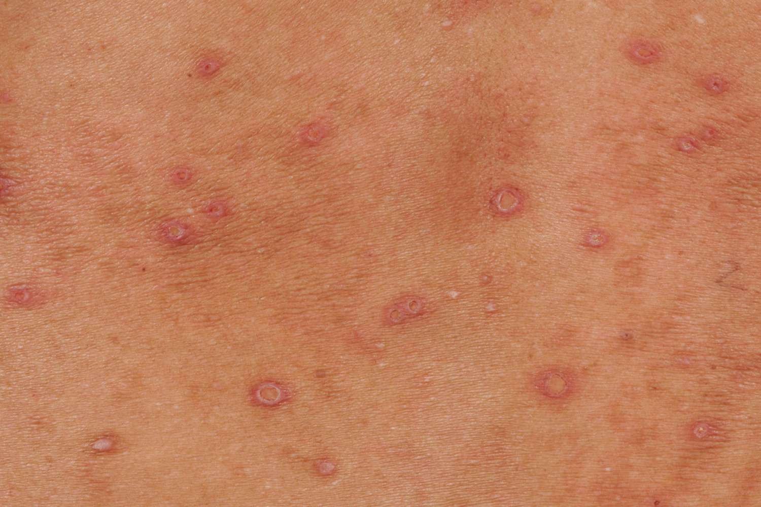 HIV 초기증상과 감별이 필요한 몸통 피부 발진 참고 사진