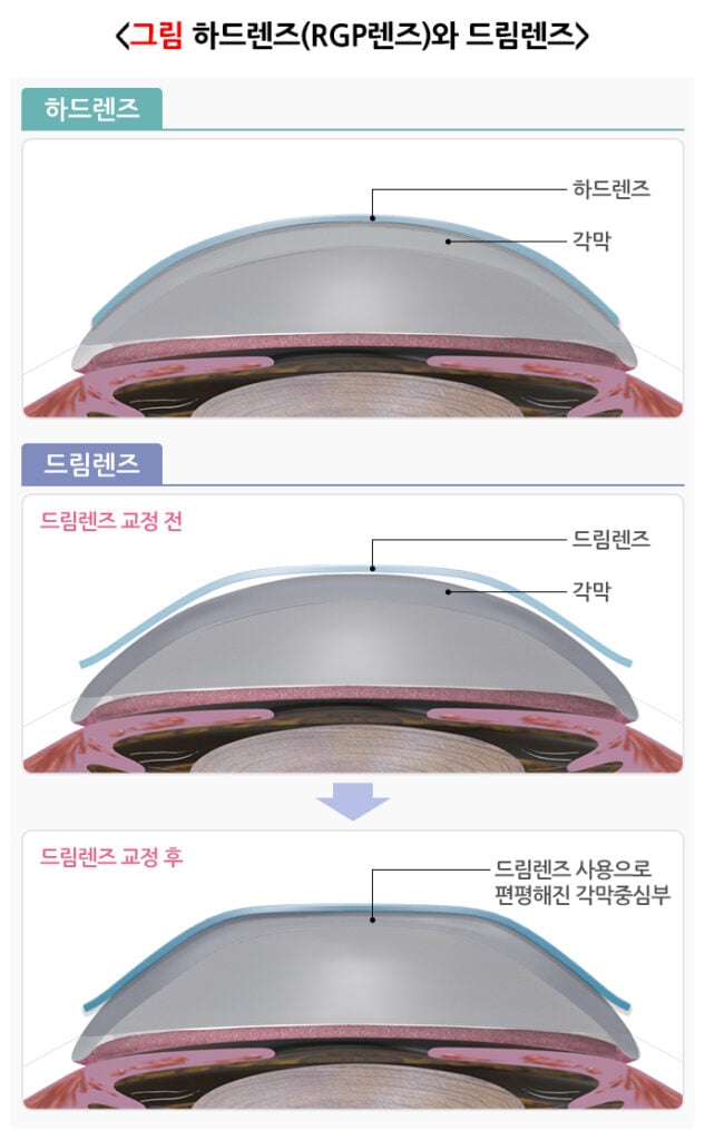 드림렌즈와 하드렌즈 비교 도식