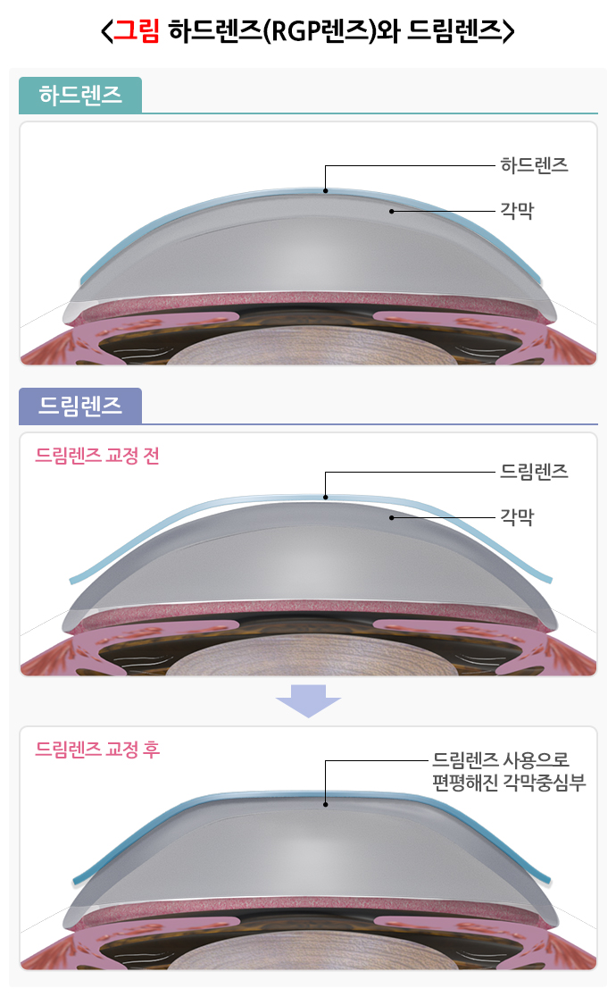 드림렌즈와 하드렌즈 비교 도식