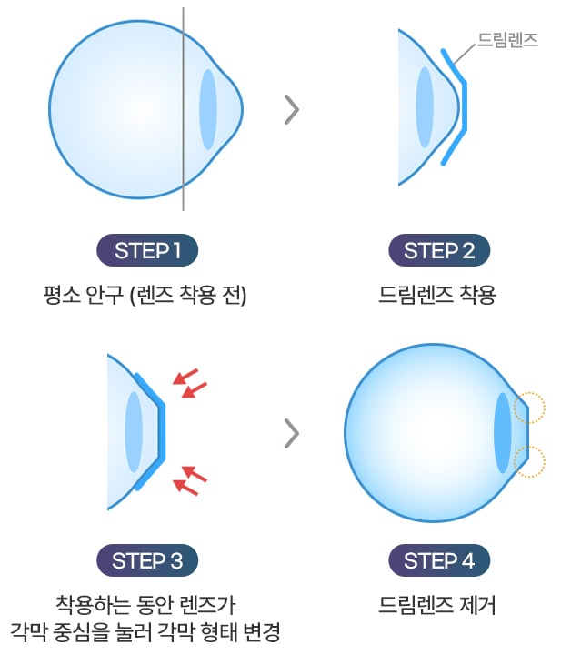 드림렌즈 원리를 설명하는 도식 이미지
